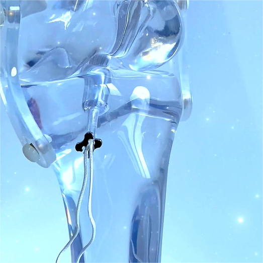Adjustable Fixation Button